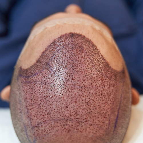 Hair Transplant — FUE/DHI natural results